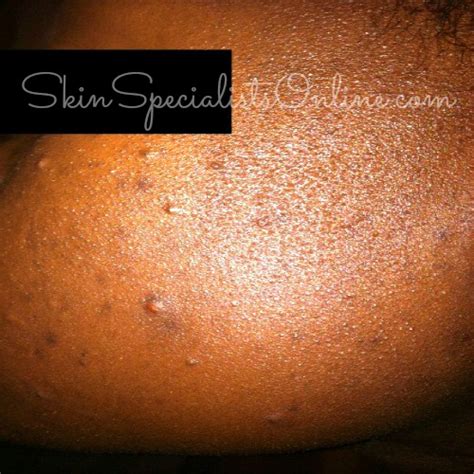 Ask A Skin Specialist Acneiform Eruptions Skin Specialists Online