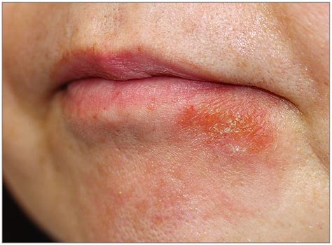 Painful And Pruritic Blisters On The Lower Lip Dermatology Jama
