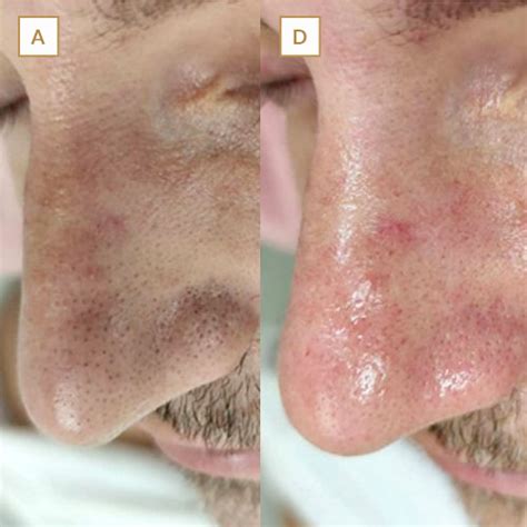 Inyección Asesinar dedo índice limpieza facial acne antes y despues