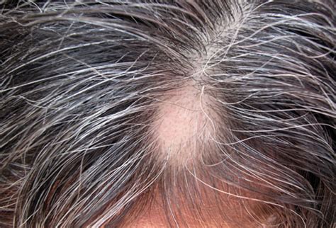 Find out more about female hair loss causes and treatments. Top 12 Remedies to Stop Hair Loss | New Health Advisor