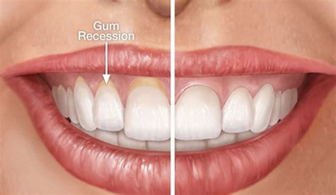 Today, it is a common surgical procedure for this reason, it's difficult to estimate exactly how much your gum graft will cost without talking to a periodontist and insurance provider first. Gum Grafting Bronx NY - Your Bronx Dentist