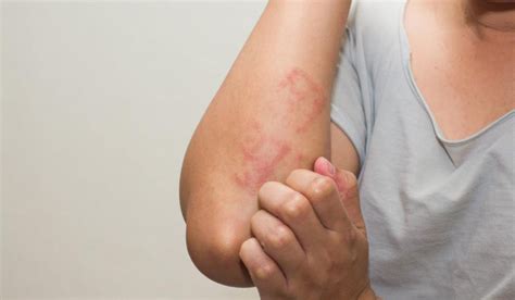 Lupus Skin Rash Symptoms And Treatment