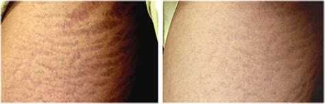 Stretch Mark Treatment Midlands Solihull Medical Cosmetic Clinic