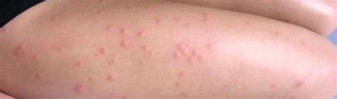 Itchy Bumps That Look Like Mosquito Bites But Arent Pestseek