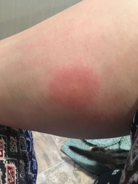 Do you have a spider bite? What the heck has bit me?! | Mumsnet