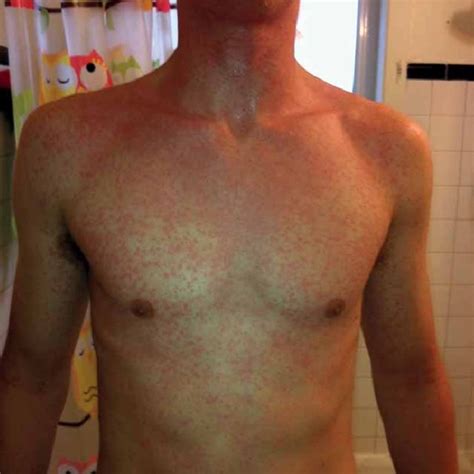 Cholinergic Urticaria Manifestation As Pinpoint Lesions After Exercise
