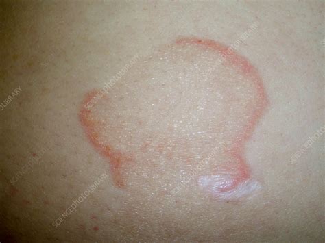 Erythema Annulare Centrifugum Stock Image C0562511 Science Photo