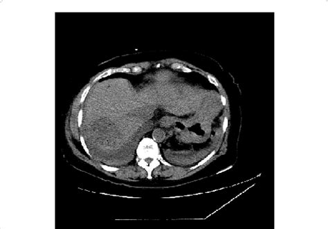 Ct Of The Abdomen Demonstrating A Fluid And Gas Containing 6 × 6 Cm