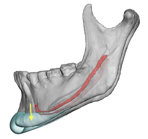 Planning The Sliding Genioplasty Bone Cuts Based On The Inferior