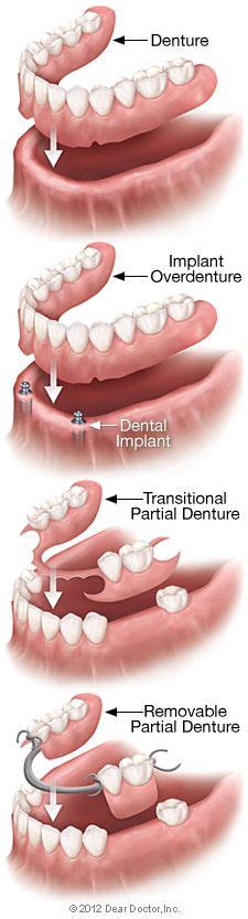 Removable Denture Types Dental Dentistry Dentist
