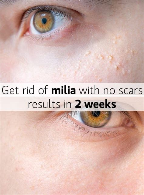Milia How To Get Rid Of White Heads Pimples On Face White Bumps On