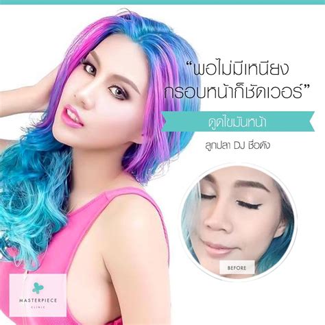 ดูดไขมันหน้า Facial Vaser Liposuction Masterpiece Clinic By Drsae