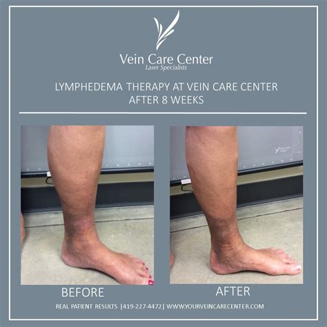 Lymphedema Therapy Before And After Lima Ohio Vein Care Center