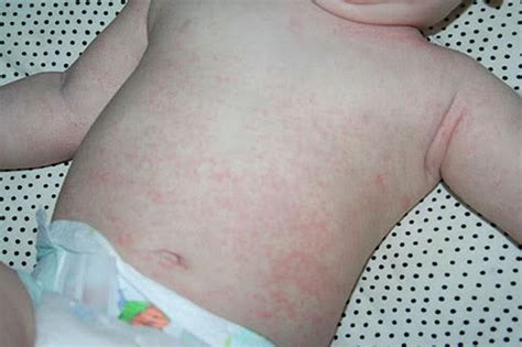 Baby Rash Pictures Causes Treatments Advice