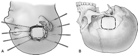 The Middle Fossa Approach Barrow