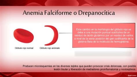 Anemia Falciforme Y Síndrome De Edwards