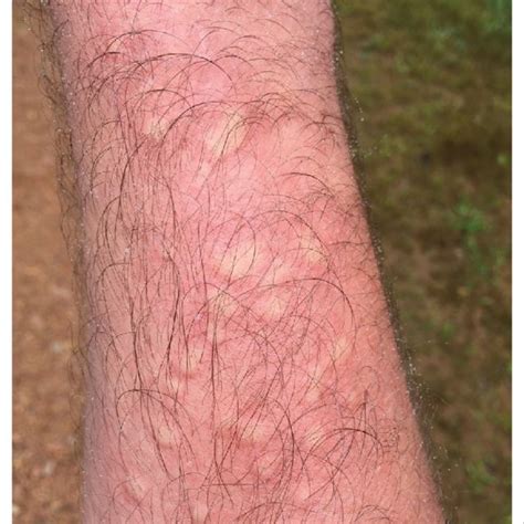Pdf Phytodermatitis A Brief Review Of Human Skin Reactions Caused By
