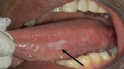 What Does Floor Of The Mouth Cancer Look Like