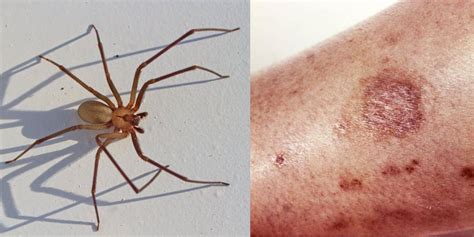 What Does Initial Brown Recluse Spider Bite Look Like Spider Bites