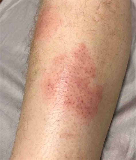 White Spots On Legs Fungal Hot Sex Picture