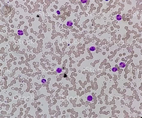 Eosinophilia Is A Condition In Which Eosinophils Count Abnormal High