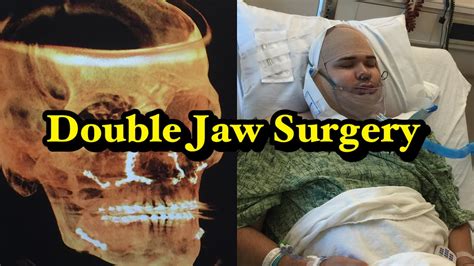 Double Jaw Surgery Journey Alehkgee Youtube