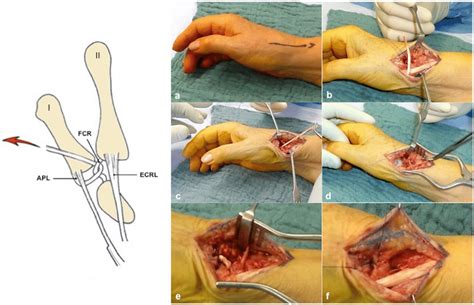 A Longitudinal Skin Incision Of Cm Over The Thumb Cmc Joint Between Download Scientific