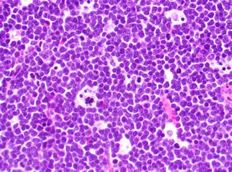 Pathology Outlines Acute Lymphoblastic Leukemia Lymphoma