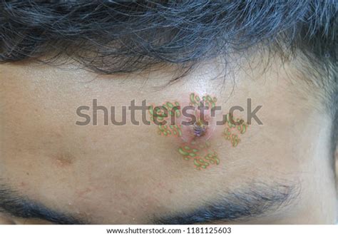 Skin Infected By Virusacne Abscess Stock Photo 1181125603 Shutterstock