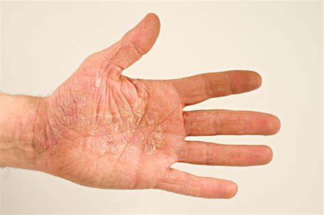 Eczema Bumps On Hands Vrogue Co
