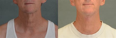 Neck Lift Before And After Pictures Case 341 Tallahassee Fl