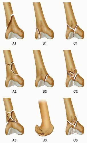 The bone can break straight across (transverse fracture) or into many pieces (comminuted fracture). Open Reduction and Internal Fixation of the Distal Femur ...