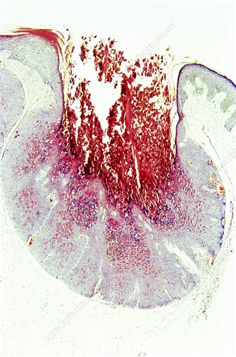 Molluscum Contagiosum Lm Stock Image C0252879 Science Photo Library