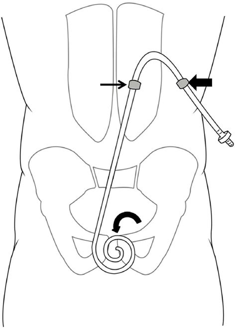 Figure 1 From Best Practices Consensus Protocol For Peritoneal Dialysis