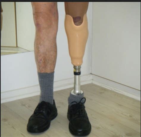 Leg Glass Or Carban Fiber Below Knee Prosthesis Rs 25000 Piece Divyang Orthotics And