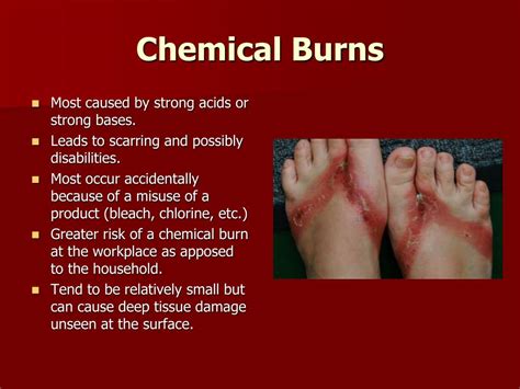 Ppt Burns Powerpoint Presentation Free Download Id2358828