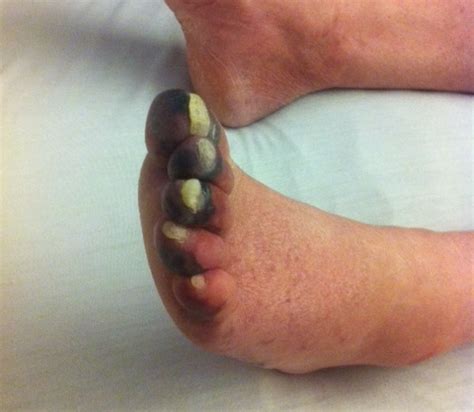 Burning feet and toes: Causes, Diagnosis and Solutions