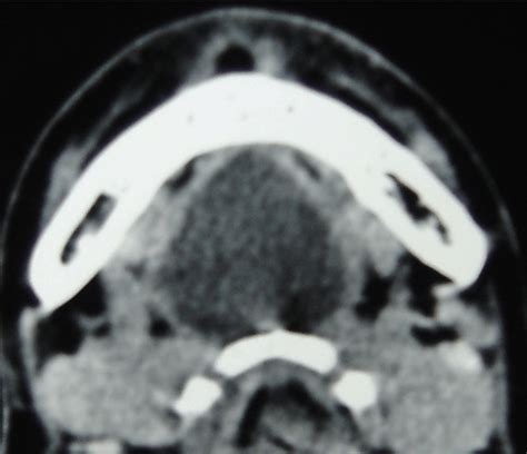 Full Text An Unusual Case Of Submental Epidermoid Cyst In A Ten Years