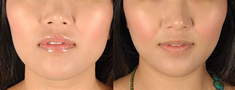 Botox For Masseters In Delhi Dermaworld Skin Clinic