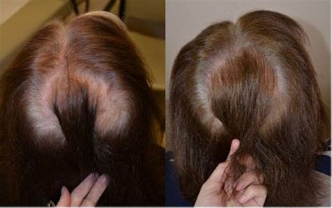 The prescribing psychiatrist told her to stop the medication and after about 2 weeks, the hair loss has stopped almost completely. Female Hair Loss Treated with Finasteride - Hair ...