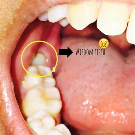 Jika gigi ini tumbuh miring maka muncul gejala bengkak, nyeri, atau bahkan demam. DOKTOR, GIGI SAYA BELAKANG SEKALI SAKIT SANGAT. KADANG ...