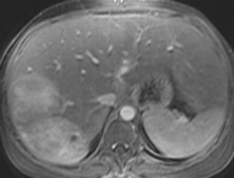 Tumors can start in the liver, or spread to the liver from another cancer in the body. Benign Liver Tumors - Oncology - Medbullets Step 2/3