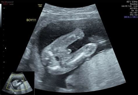 Fetal Gender Ultrasound Selangor Puchong Kuala Lumpur Kl Malaysia Abdomen Scan Services