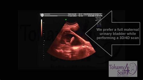 The 20 Weeks Anomaly 4d Scan Youtube
