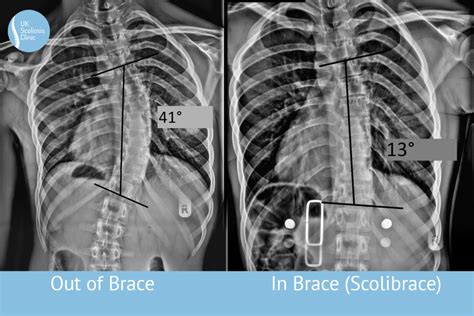 Scolibrace 1 Scoliosis Clinic Uk Treating Scoliosis Without Surgery