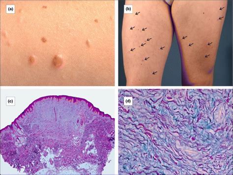 Multiple Eruptive Myxoid Dermatofibromas A Clinical Appearance Of