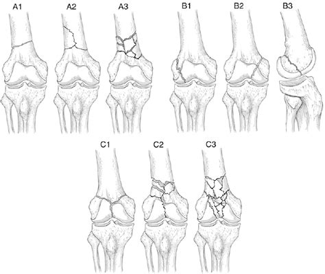 Classification—the ota classification is the universally accepted system for characterizing injuries of the distal femur. Surgical treatment of distal femoral fractures using a ...