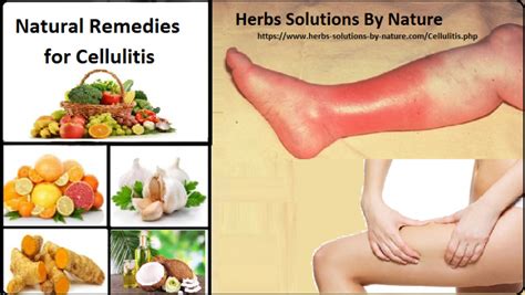 Natural Herbal Remedies For Cellulitis Natural Herbal Remedies