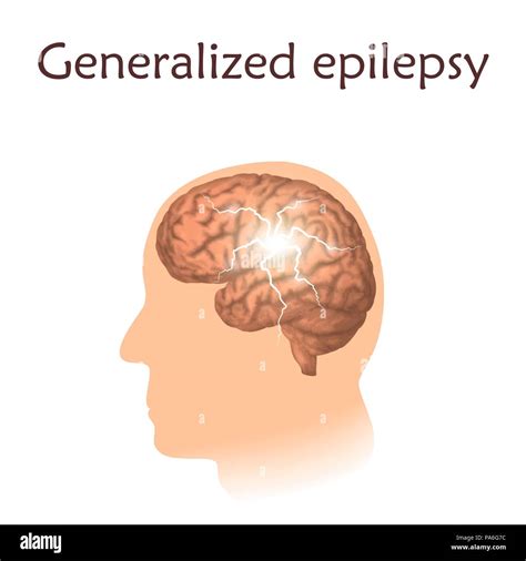 Generalisierte Epilepsie Illustration Elektrische Im Gesamten Gehirn