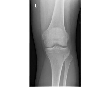 This is a so called segond fracture. AP Knee X-Ray Anatomy